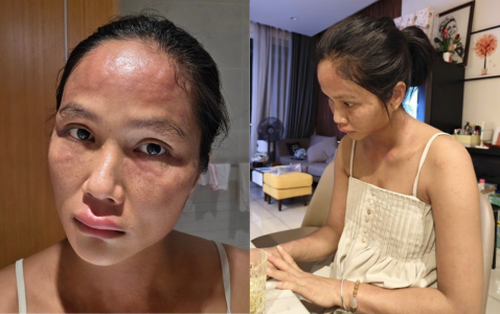 Gương mặt biến dạng sau sinh của H'Hen Niê