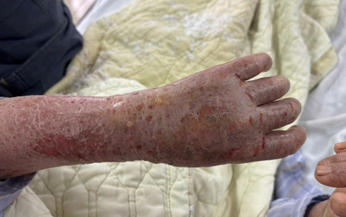 Người phụ nữ bị ngứa dữ dội đến mức “ảo giác có sâu bò”: Nguyên nhân gây sốc từ thói quen nhiều người Việt vẫn làm