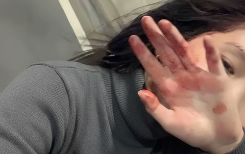 6 bất thường ở bàn tay đang ám chỉ lượng đường trong máu vượt ngưỡng an toàn, tiếc là rất ít người để ý!