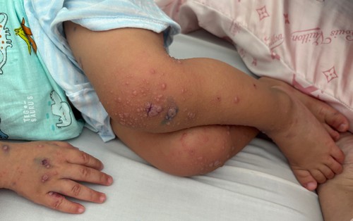 Nhiều trẻ mắc tay chân miệng trở nặng do tác nhân EV71, bác sĩ khuyến cáo gì?