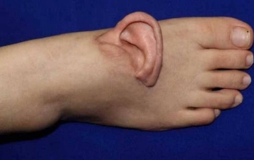 Nối lại tai đã đứt rời sau khi nuôi ở bàn chân suốt 5 tháng