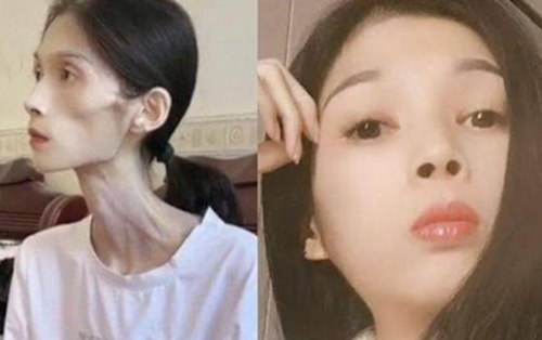 Hình ảnh cô gái 27 tuổi chỉ nặng 17kg vì viêm teo dạ dày gây xót xa: Căn bệnh không thể xem nhẹ, người trẻ cũng cần cảnh giác