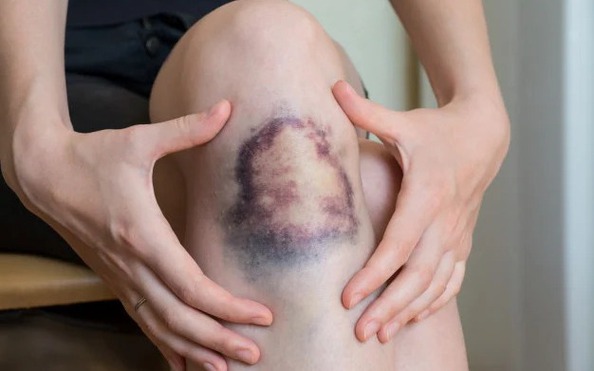 BẤT THƯỜNG TRÊN DA: tin tức Mới nhất Vạch trần 4 tín hiệu ung thư thận qua làn da, bác sĩ: "Đừng chỉ biết kiểm tra nước tiểu" - Đọc tin tuc