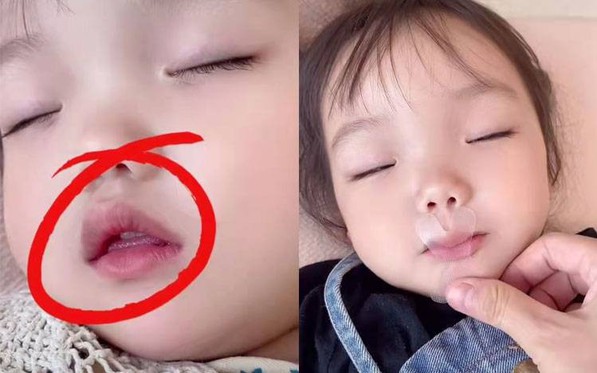 Thấy con gái 8 tuổi ngủ mở miệng, mẹ dùng băng keo dán khiến bé suýt ngạt thở, bác sĩ chỉ ra sai lầm