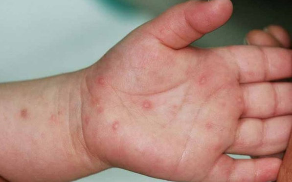 Hà Nội: Dịch tay chân miệng gia tăng, dịch sởi chưa giảm nhiệt