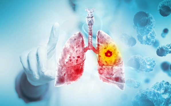 3 tín hiệu là "cảnh báo đỏ" của ung thư phổi: Sau 40 tuổi càng phải chú ý