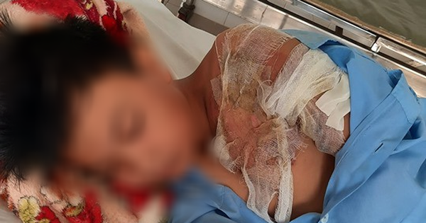Xác minh thông tin bé trai ở Long An bị cha đẻ bạo hành, đổ nước sôi khiến bỏng nặng phải nhập viện
