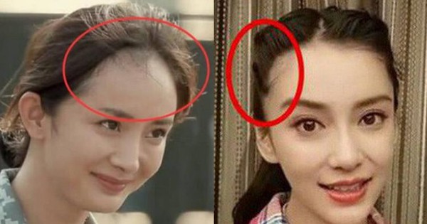 Hair Loss Problem Of Showbiz Stars Duong Mi