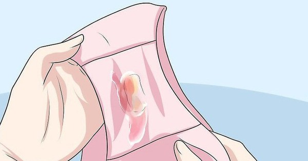 Dịch âm đạo tiết ra nhiều bất thường có thể đến từ những nguyên nhân mà bạn chẳng ngờ tới