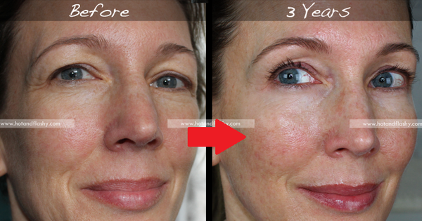 Đắn đo trước hiệu quả chống già của retinol? Minh chứng người phụ nữ sau 3 năm kiên trì với làn da như photoshop sẽ khiến bạn vững tin