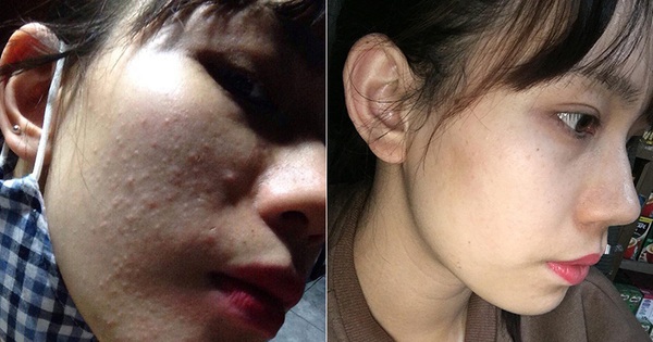 Thay liên tục 5 lọ tẩy trang, cuối cùng cô nàng cũng tìm ra chân ái của cuộc đời: Da giảm hẳn mụn và vết thâm cũng chẳng còn