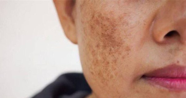 Nữ giới có tử cung khỏe mạnh thường không gặp 3 vấn đề xuất hiện trên khuôn mặt, nếu bạn cũng vậy thì xin chúc mừng - Vimarsana News