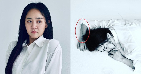 “Nation’s little sister” Moon Geun Young revealed after 4 surgeries, pitying the wound extending to half of her arm