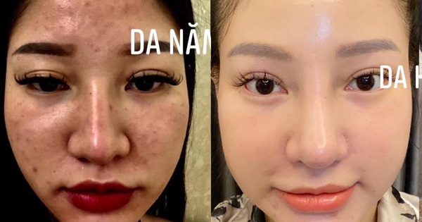 Once stuck with cream mixed with medicinal alcohol, she turned from acne skin to smooth and shiny thanks to skincare with a series of popular dishes