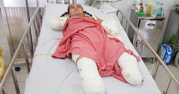 Woman loses limbs to electric shock while using iron to pick mangoes for her children