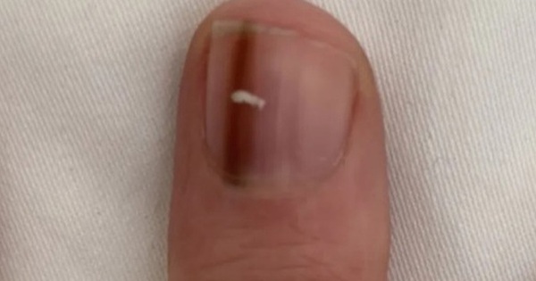 Going to the doctor because of strange marks on her nails, the woman was shocked when she discovered the scary culprit