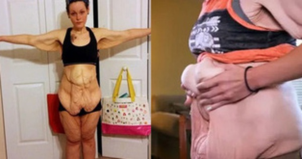 Determined to lose 152kg to make her daughter proud, the woman regretted her weird body and unbelievable transformation afterwards.