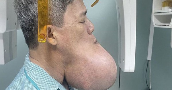 Man with a giant tumor on his face