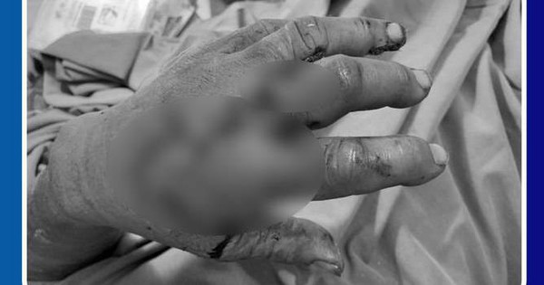 Man arrives at the hospital with two severed fingers that are frozen