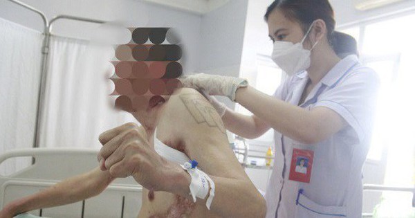 Quang Ninh man has sores and scars all over his body because of rare pus secretion from sweat