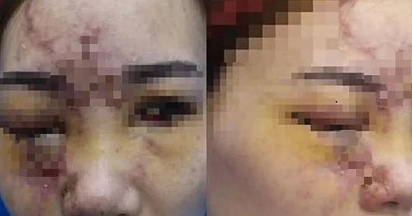 Complications of filler injection “disguised” collagen