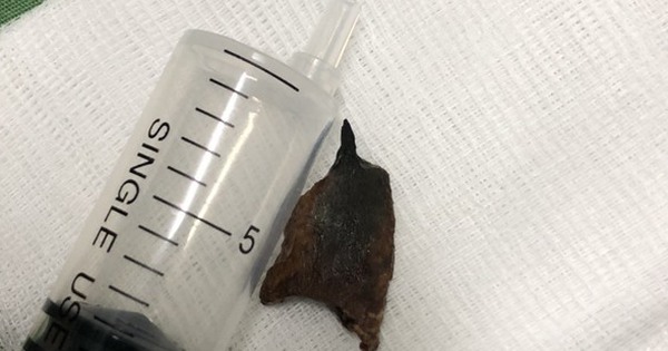 The man for 20 years has a pig bone in his lungs