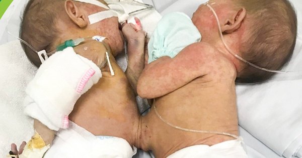 Conjoined twins are rare, 200,000 babies have only 1 case