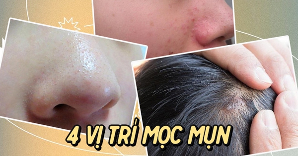 4 acne spots on your face indicate your bad habits, why don’t you check it yourself right away
