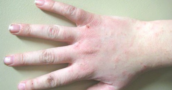 Itchy skin this season is not necessarily caused by an allergy, if it is itchy in 3 places, it may be a sign of HPV infection.
