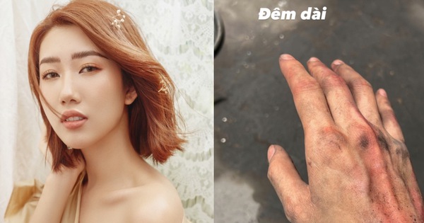 1 female star causes anxiety with the image of a bruised hand, with a hidden caption attached