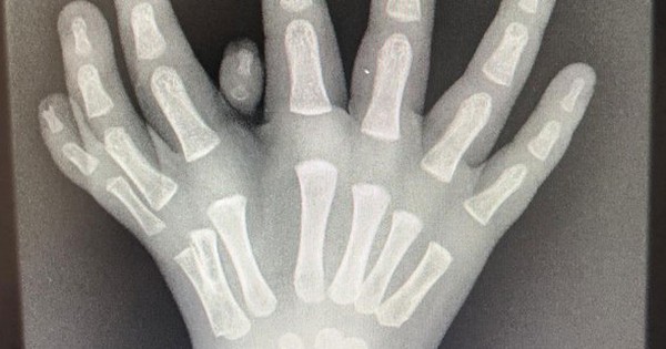 Boy has a rare 8-fingered hand