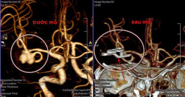 Cerebral blood vessel ruptured while singing karaoke, female patient had to have surgery to save her life