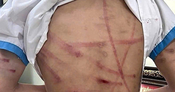 Bé gái lớp 5 ở Hà Tĩnh bị cha dượng bạo hành dã man: Đây không phải lần đầu