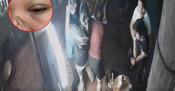 Hà Nội: Người phụ nữ tố bị thanh niên lạ mặt đánh gẫy xương hốc mắt, hé lộ nguồn cơn đầy bất bình