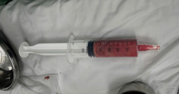 Cô gái 20 tuổi trở về từ Malaysia nhập viện cấp cứu vì ngực rỉ dịch xanh bất thường sau một mũi tiêm