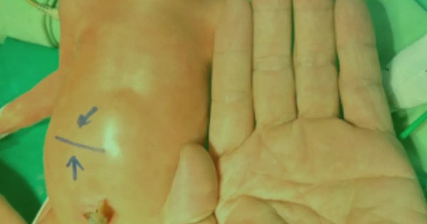 Viêm ruột hoại tử đe dọa tính mạng trẻ sinh non