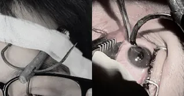 Nguy cơ mất thị lực do móc câu cá cắm vào mắt