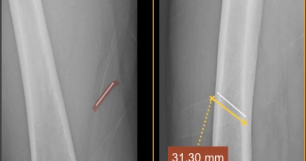 Gắp dị vật kim loại sâu do tai nạn lao động