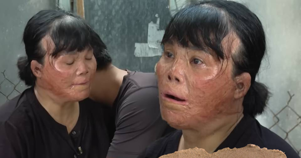 Người phụ nữ Đồng Tháp bỏng 78%, gương mặt biến dạng vì cứu một bé trai khỏi đám cháy, suốt 18 năm vẫn nuôi như con ruột