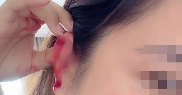 Hà Nội: Cô gái cầu cứu sau khi bị bạn cùng phòng trọ hành hung rách tai vì lấy nhầm nồi nấu ăn