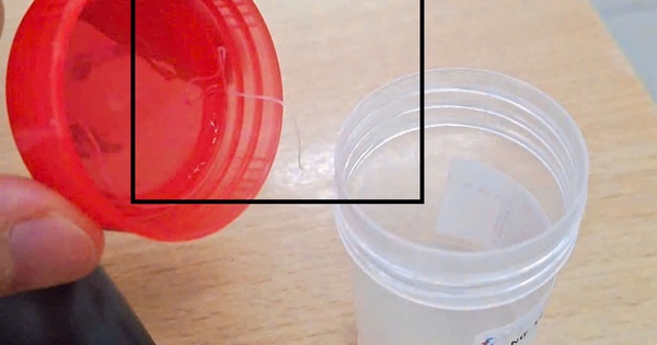 Bệnh viện Bệnh Nhiệt đới Trung ương tiếp nhận điều trị 1 trường hợp hiếm gặp