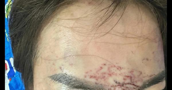 Một phụ nữ ở Cà Mau tố bị xăm mặt, cắt tóc... vì ghen