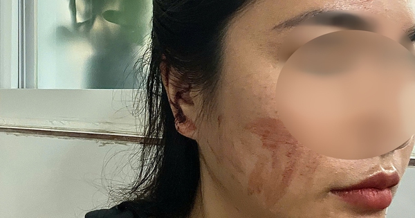 Kết quả giám định vụ cô gái cầu cứu sau khi bị bạn cùng phòng trọ hành hung rách tai vì lấy nhầm nồi nấu ăn