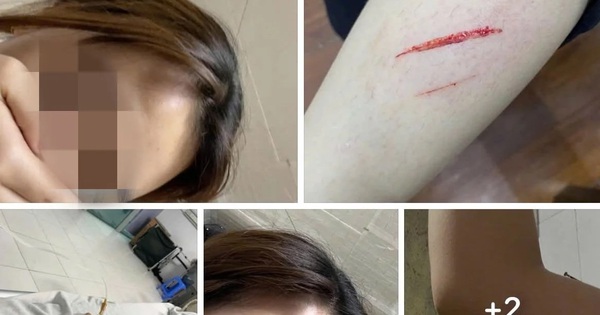 Tình hình sức khoẻ hiện tại của nữ sinh bị đánh nhập viện vì mâu thuẫn "tiền tip" ở Hà Nội