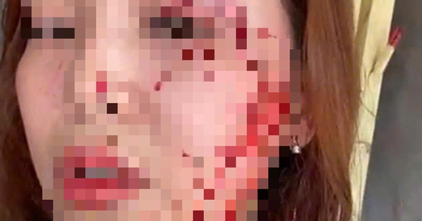 Khởi tố vụ một phụ nữ "bị người không quen biết rạch mặt"