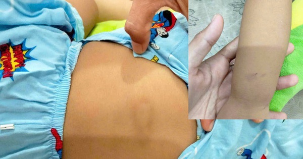 Bình Thuận: Cháu bé 3 tuổi nghi bị bạo hành tại điểm giữ trẻ tự phát