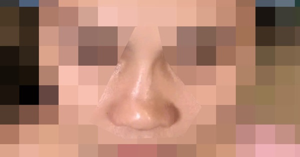 Sợ động dao kéo, nữ sinh nâng mũi bằng chỉ, 1 năm sau mũi biến dạng