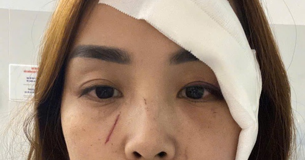 Một phụ nữ ở Nha Trang tố cáo "bị người không quen biết rạch mặt"