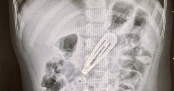 Hà Nội: Bé gái 21 tháng tuổi nhập viện sau khi nuốt một chiếc kẹp tóc kim loại