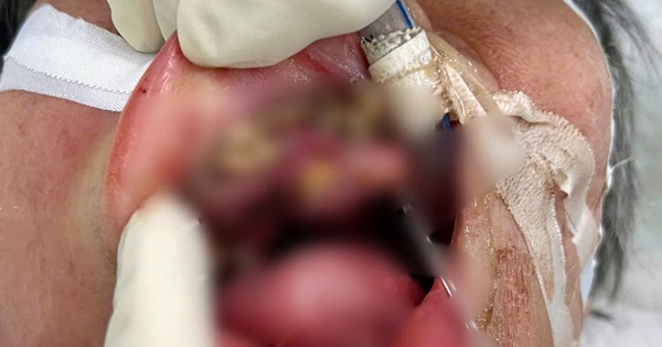 Bác sĩ ở Đà Nẵng gắp hơn 100 con giòi làm tổ trong miệng cụ bà 69 tuổi